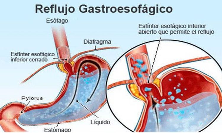 enfermedad-reflujo-gastroesofagico