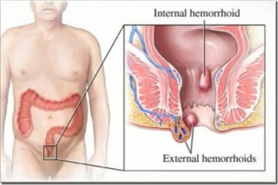 hemorroides